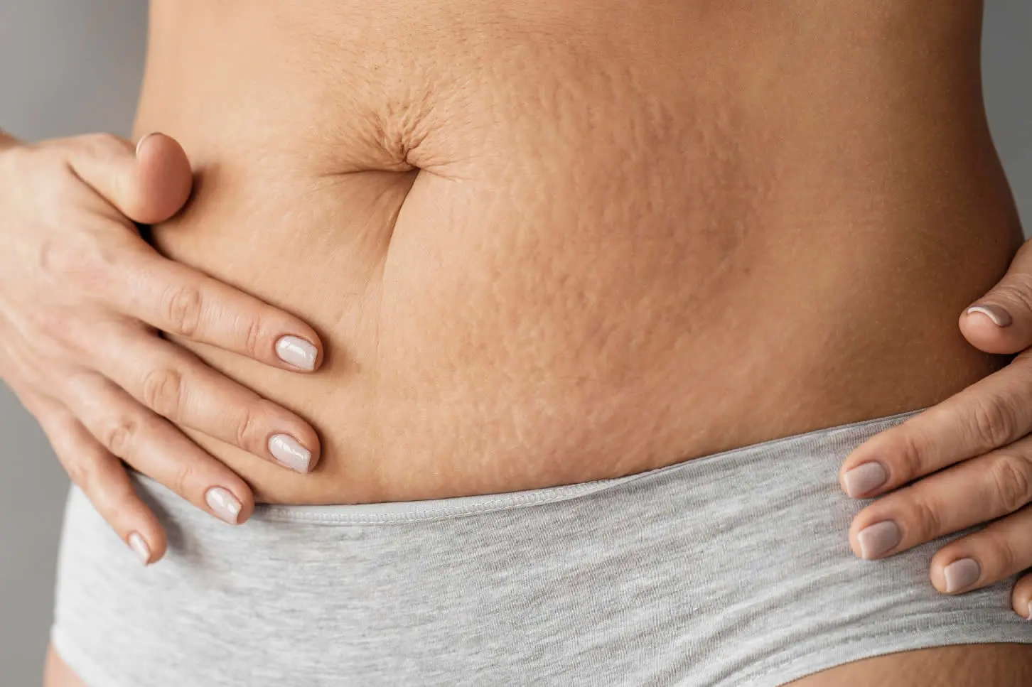 medical dermatology woman close-up-woman-with-stretch-marks